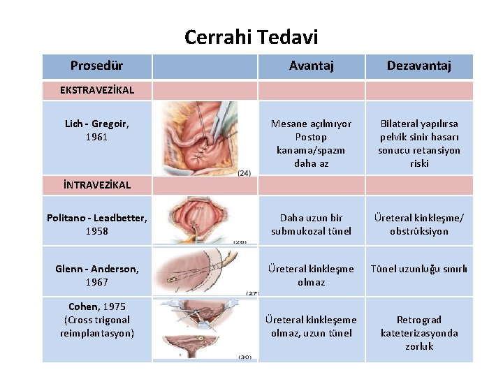 Cerrahi Tedavi Prosedür Avantaj Dezavantaj Mesane açılmıyor Postop kanama/spazm daha az Bilateral yapılırsa pelvik