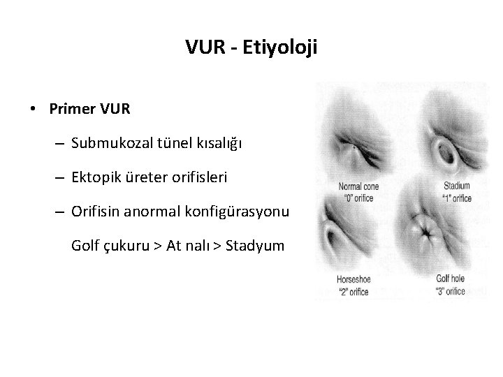 VUR - Etiyoloji • Primer VUR – Submukozal tünel kısalığı – Ektopik üreter orifisleri