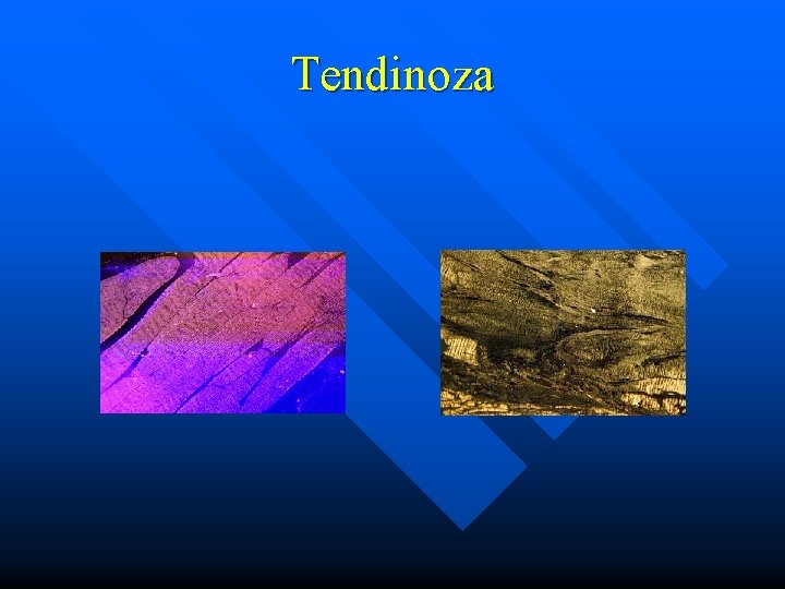 Tendinoza 