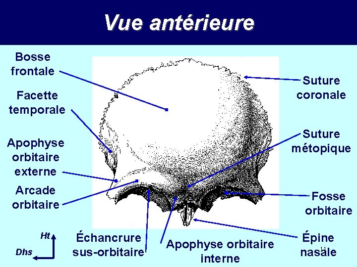 Vue antérieure Bosse frontale Suture coronale Facette temporale Suture métopique Apophyse orbitaire externe Arcade Vue antérieure Bosse frontale Suture coronale Facette temporale Suture métopique Apophyse orbitaire externe Arcade
