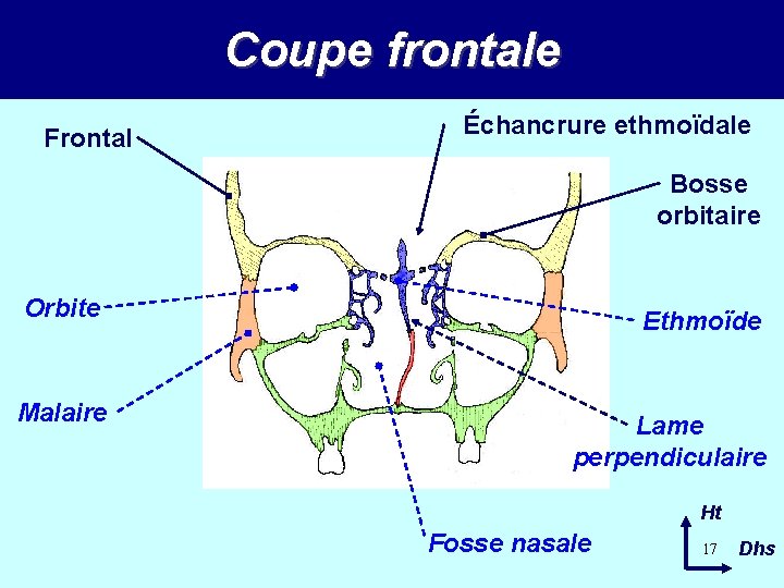 Coupe frontale Frontal Échancrure ethmoïdale Bosse orbitaire Orbite Ethmoïde Malaire Lame perpendiculaire Ht Fosse Coupe frontale Frontal Échancrure ethmoïdale Bosse orbitaire Orbite Ethmoïde Malaire Lame perpendiculaire Ht Fosse