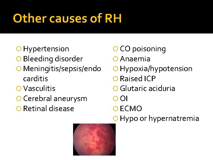 Other causes of RH Hypertension Bleeding disorder Meningitis/sepsis/endo carditis Vasculitis Cerebral aneurysm Retinal disease