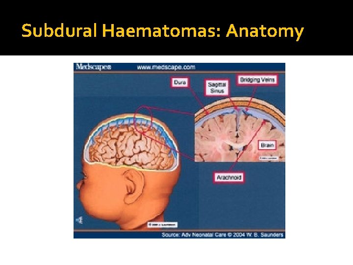 Subdural Haematomas: Anatomy 