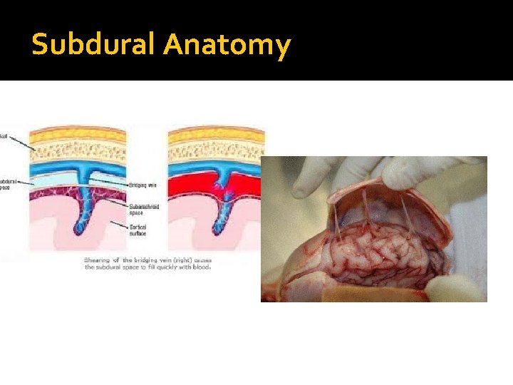 Subdural Anatomy 