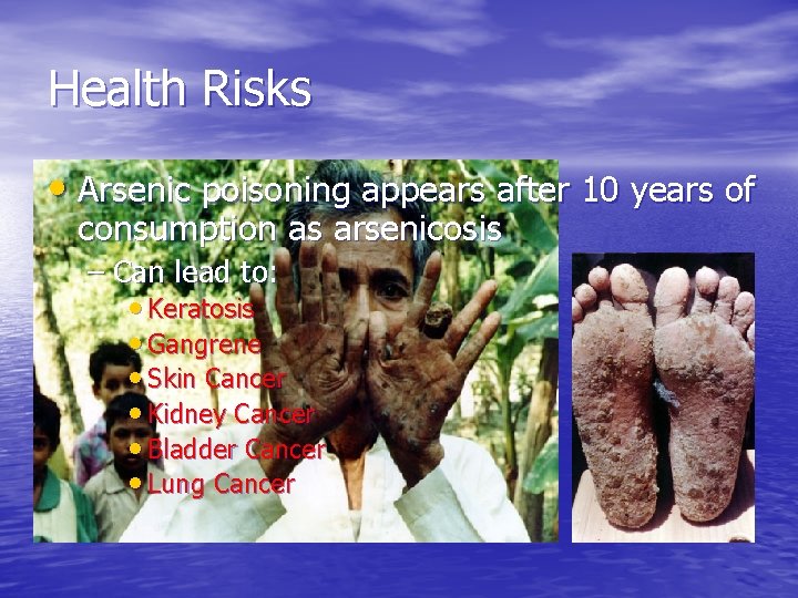 Health Risks • Arsenic poisoning appears after 10 years of consumption as arsenicosis –