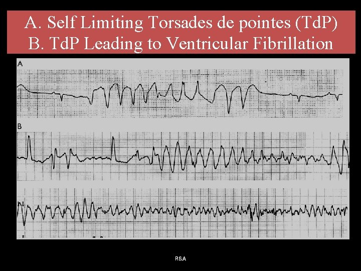 A. Self Limiting Torsades de pointes (Td. P) B. Td. P Leading to Ventricular