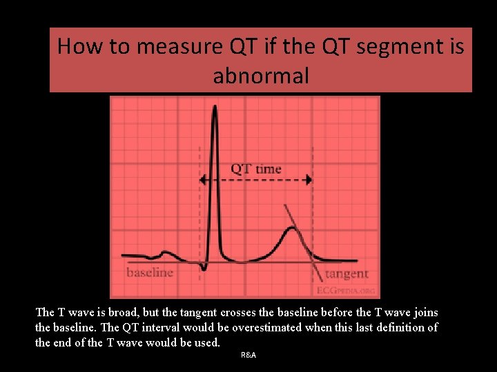 How to measure QT if the QT segment is abnormal The T wave is