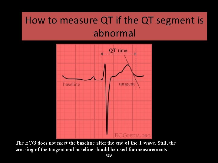 How to measure QT if the QT segment is abnormal The ECG does not
