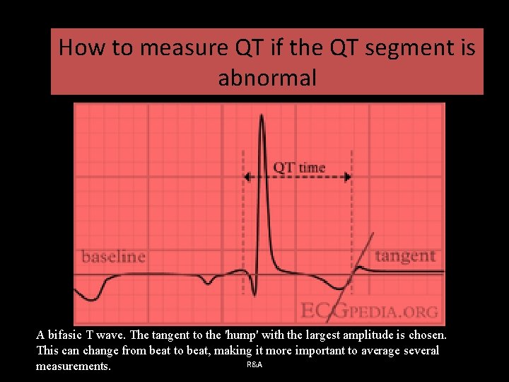 How to measure QT if the QT segment is abnormal A bifasic T wave.