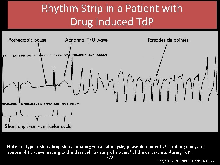 Rhythm Strip in a Patient with Drug Induced Td. P Note the typical short-long-short