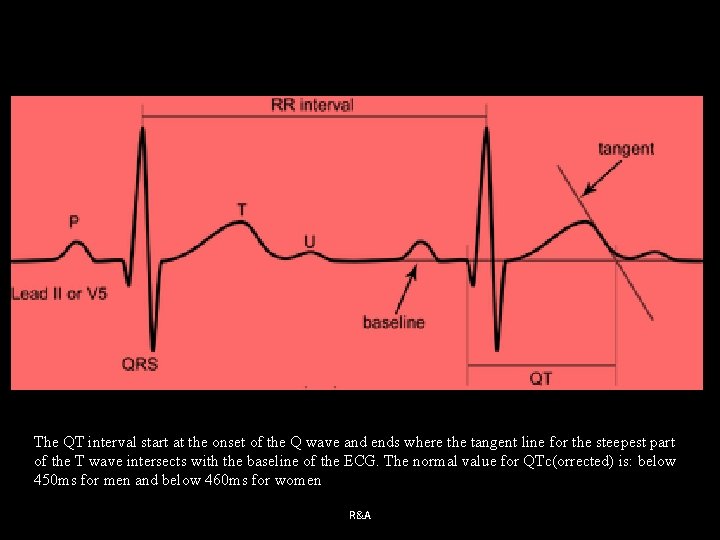 The QT interval start at the onset of the Q wave and ends where