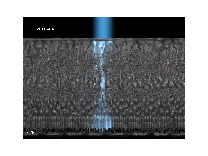 vitreous RPE 