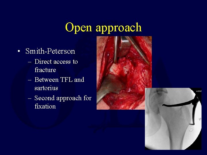 Open approach • Smith-Peterson – Direct access to fracture – Between TFL and sartorius