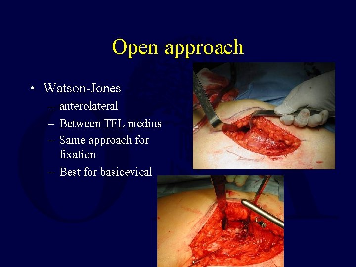 Open approach • Watson-Jones – anterolateral – Between TFL medius – Same approach for