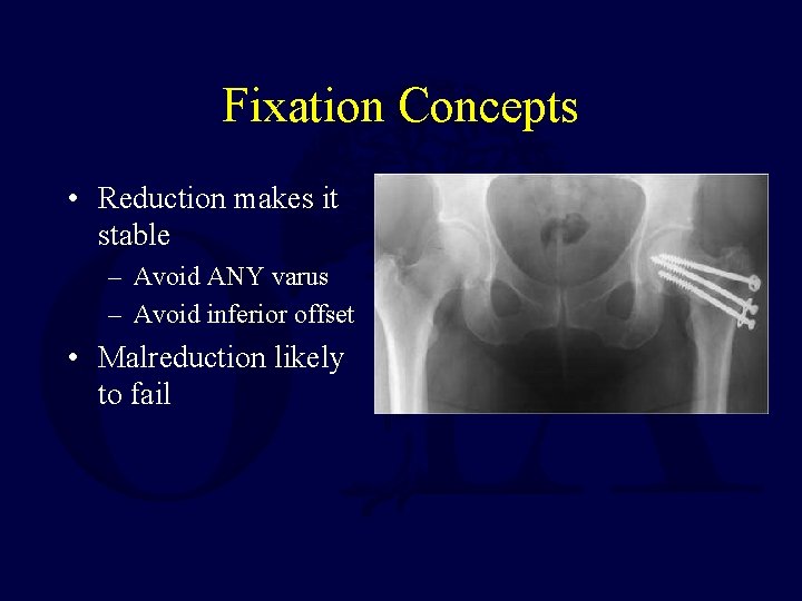 Fixation Concepts • Reduction makes it stable – Avoid ANY varus – Avoid inferior