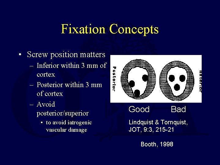 Fixation Concepts • Screw position matters – Inferior within 3 mm of cortex –