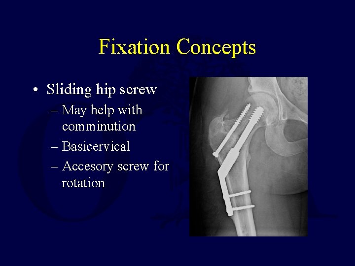 Fixation Concepts • Sliding hip screw – May help with comminution – Basicervical –