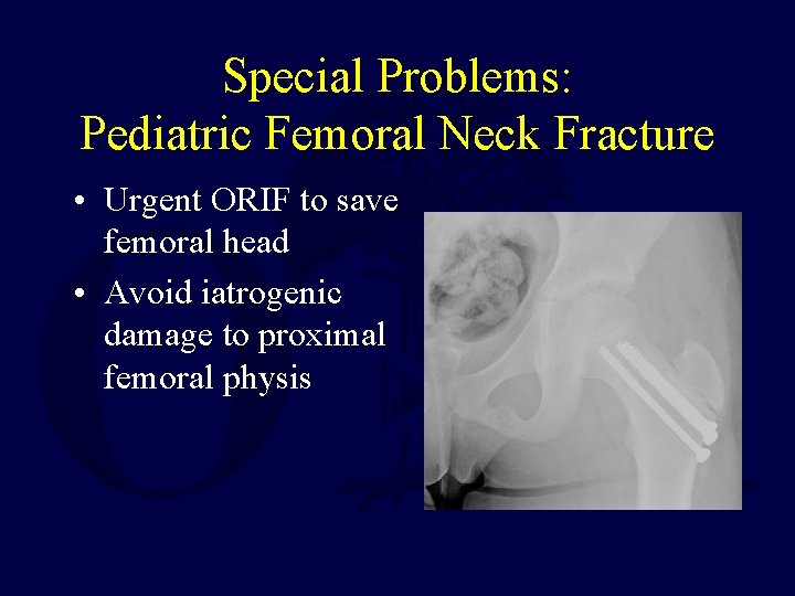 Special Problems: Pediatric Femoral Neck Fracture • Urgent ORIF to save femoral head •