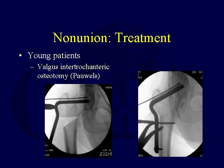 Nonunion: Treatment • Young patients – Valgus intertrochanteric osteotomy (Pauwels) 