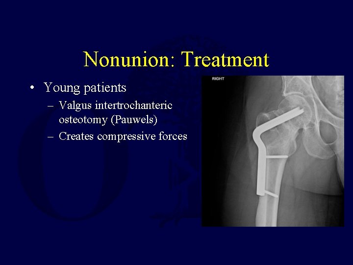 Nonunion: Treatment • Young patients – Valgus intertrochanteric osteotomy (Pauwels) – Creates compressive forces