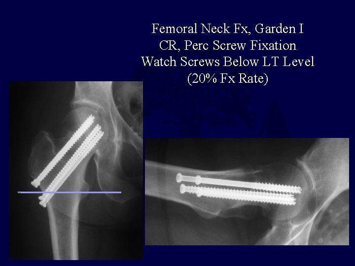 Femoral Neck Fx, Garden I CR, Perc Screw Fixation Watch Screws Below LT Level