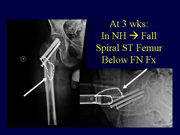 At 3 wks: In NH Fall Spiral ST Femur Below FN Fx 