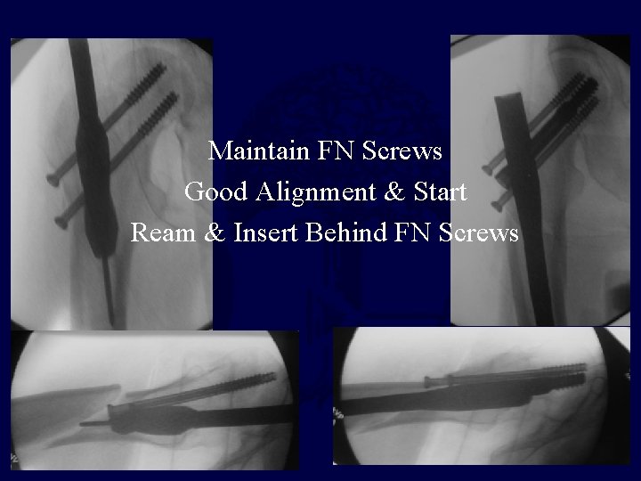 Maintain FN Screws Good Alignment & Start Ream & Insert Behind FN Screws 