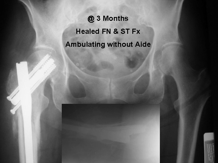 @ 3 Months Healed FN & ST Fx Ambulating without Aide 