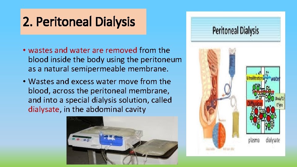 2. Peritoneal Dialysis • wastes and water are removed from the blood inside the