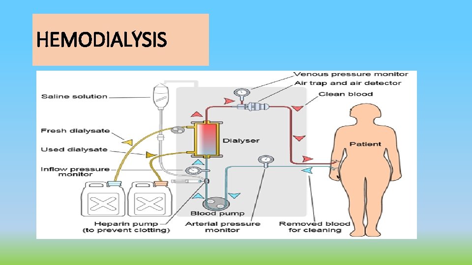 HEMODIALYSIS 