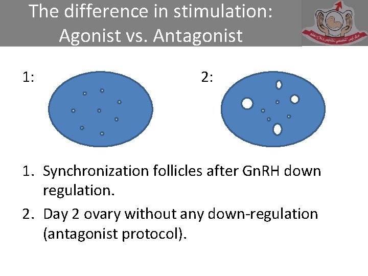 The difference in stimulation: Agonist vs. Antagonist 1: 2: 1. Synchronization follicles after Gn.