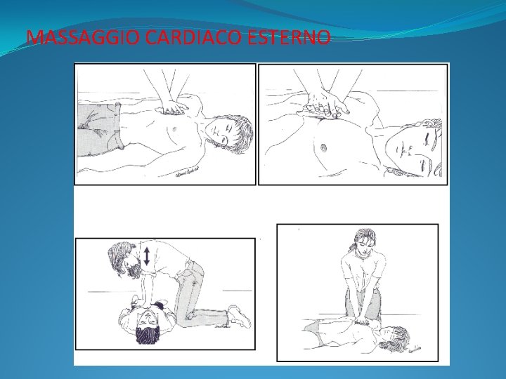 MASSAGGIO CARDIACO ESTERNO 