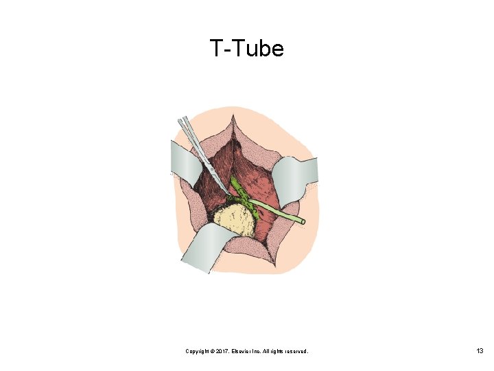 T-Tube Copyright © 2017, Elsevier Inc. All rights reserved. 13 