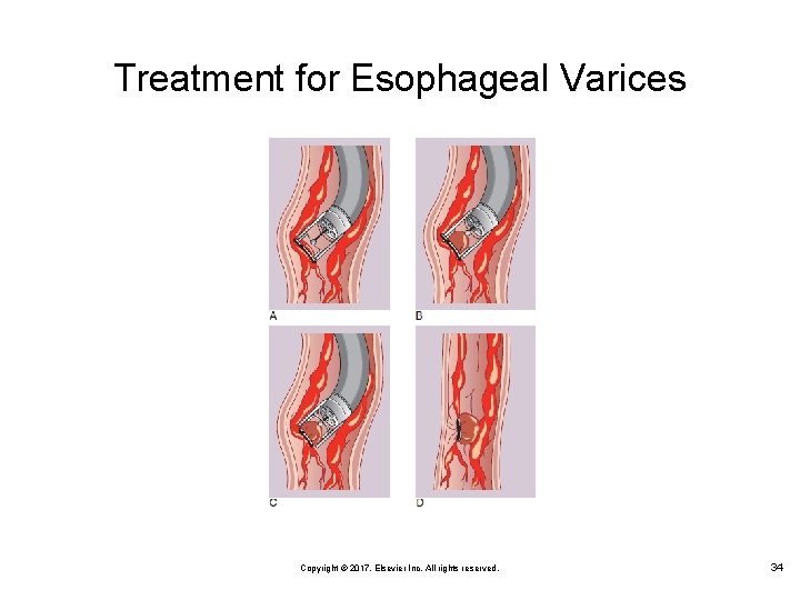 Treatment for Esophageal Varices Copyright © 2017, Elsevier Inc. All rights reserved. 34 
