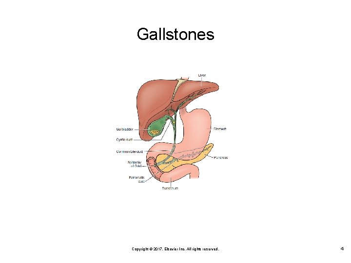 Gallstones Copyright © 2017, Elsevier Inc. All rights reserved. 4 