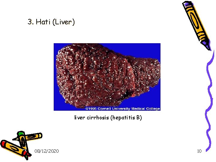 3. Hati (Liver) liver cirrhosis (hepatitis B) 08/12/2020 10 