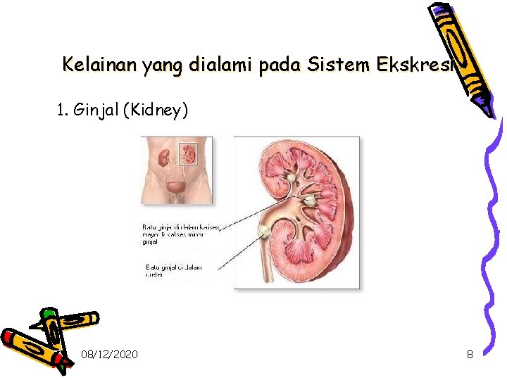 Kelainan yang dialami pada Sistem Ekskresi 1. Ginjal (Kidney) 08/12/2020 8 