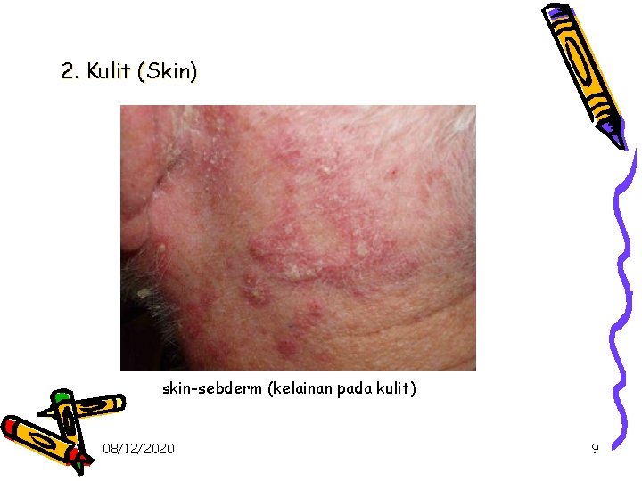 2. Kulit (Skin) skin-sebderm (kelainan pada kulit) 08/12/2020 9 