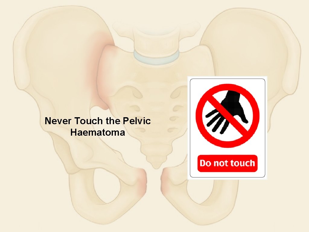 Never Touch the Pelvic Haematoma 