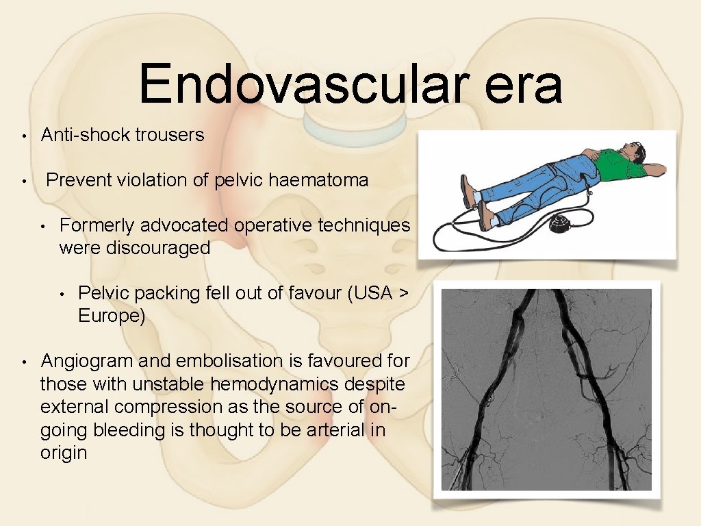 Endovascular era • Anti-shock trousers Prevent violation of pelvic haematoma • • Formerly advocated
