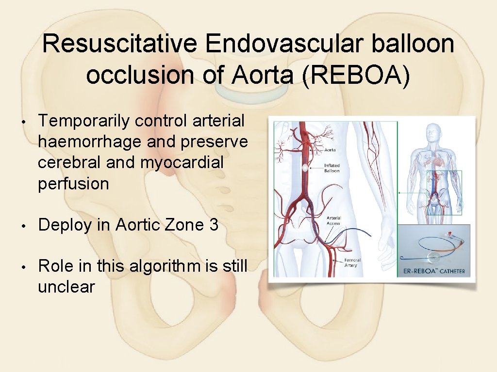 Resuscitative Endovascular balloon occlusion of Aorta (REBOA) • Temporarily control arterial haemorrhage and preserve