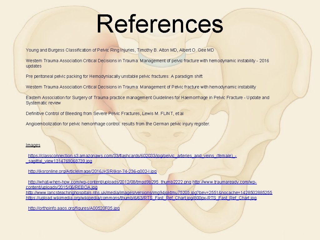 References Young and Burgess Classification of Pelvic Ring Injuries, Timothy B. Alton MD, Albert