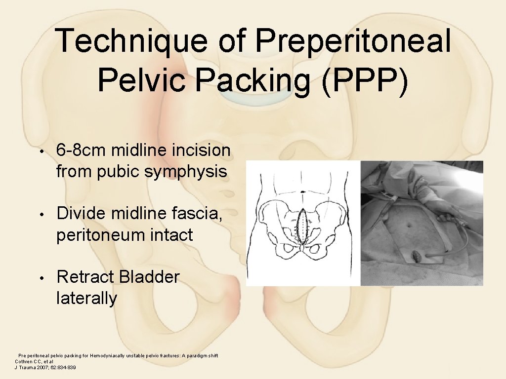 Technique of Preperitoneal Pelvic Packing (PPP) • 6 -8 cm midline incision from pubic