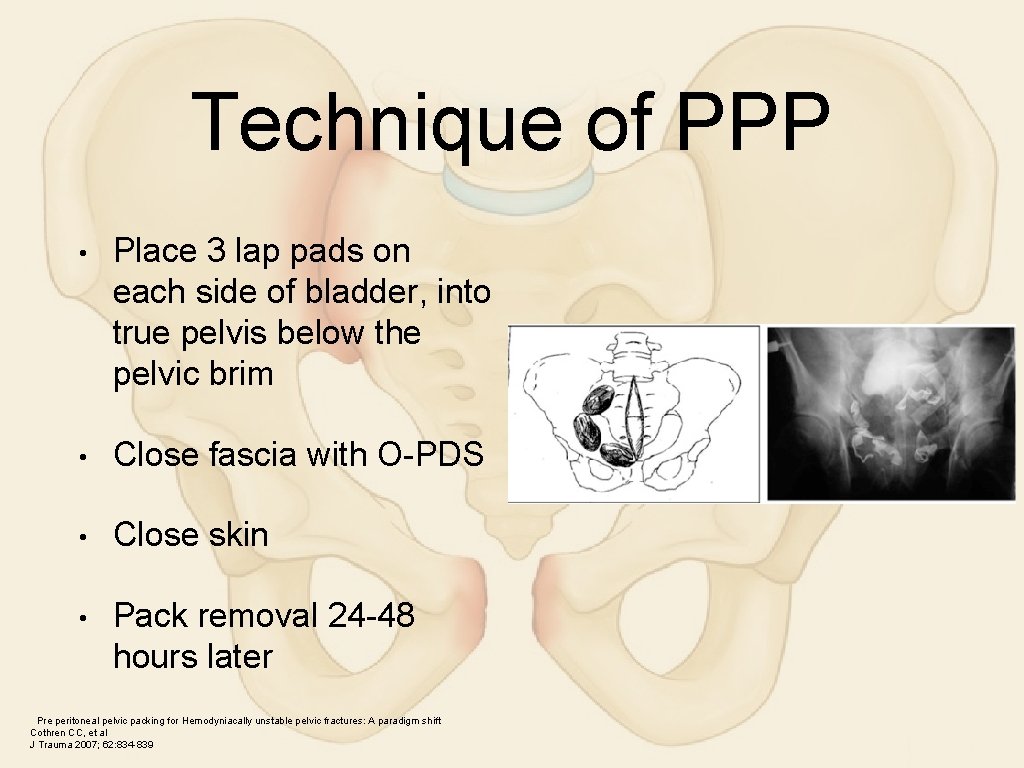 Technique of PPP • Place 3 lap pads on each side of bladder, into