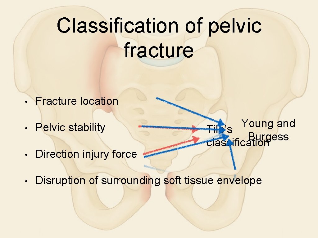 Classification of pelvic fracture • Fracture location • Pelvic stability • Direction injury force
