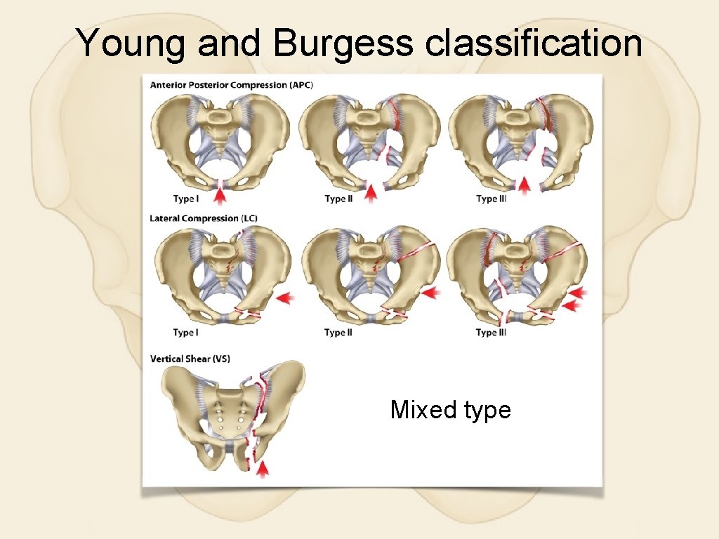 Young and Burgess classification Mixed type 