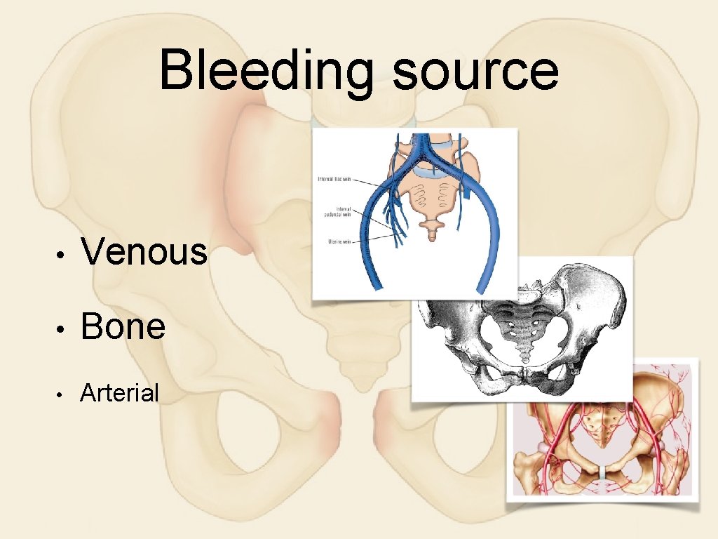 Bleeding source • Venous • Bone • Arterial 