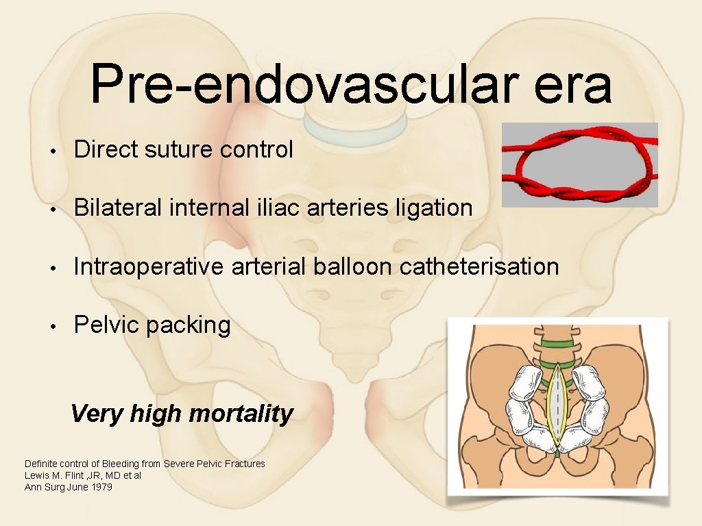 Pre-endovascular era • Direct suture control • Bilateral internal iliac arteries ligation • Intraoperative