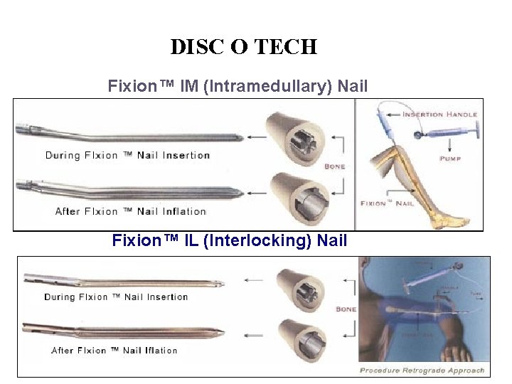 DISC O TECH Fixion™ IM (Intramedullary) Nail Fixion™ IL (Interlocking) Nail 