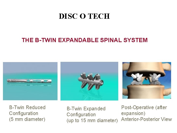 DISC O TECH THE B-TWIN EXPANDABLE SPINAL SYSTEM B-Twin Reduced Configuration (5 mm diameter)